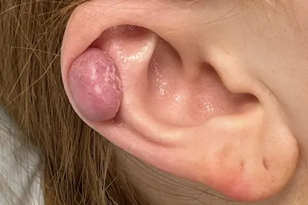 Keloid & Mucocoele Excision - Dr Nikita Iyer