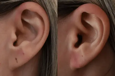 Lobuloplasty - Dr Nikita Iyer